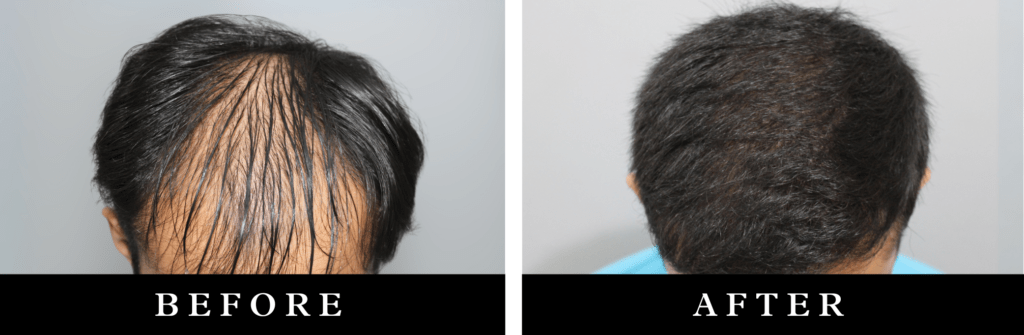 Natural hairline creation results showing a seamless and restored hairline after hair transplant, performed at Elrevo Clinic by Dr. Ram Chilgar.