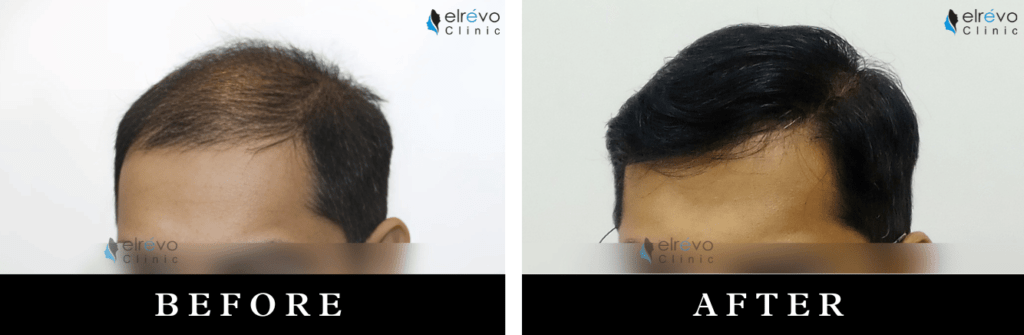 Advanced hair restoration before and after using FUE at Elrevo Clinic with Dr. Ram Chilgar.