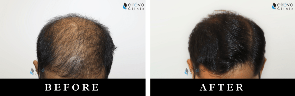 Advanced hair restoration before and after using FUE at Elrevo Clinic with Dr. Ram Chilgar.