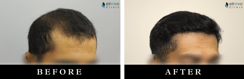 Before and after of advanced hair thinning FUE hair restoration at Elrevo Clinic by Dr. Ram Chilgar.