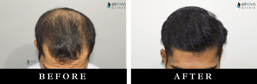 Before and after of advanced hair thinning FUE hair restoration at Elrevo Clinic by Dr. Ram Chilgar.
