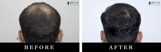 Advanced crown hair transplant results at Elrevo Clinic, showcasing the successful restoration of natural hair growth in the crown area using the latest FUE technique under the expertise of Dr. Ram Chilgar.