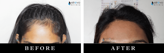 Before and after images of a female hair transplant performed at Elrevo Clinic by Dr. Ram Chilgar, showcasing significant hair restoration and regrowth using advanced FUE techniques.