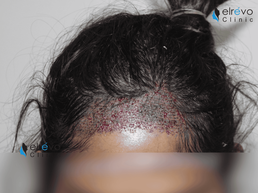 Explore the innovative Female Unshaven Hair Transplant at Elrevo Clinic, led by Dr. Ram Chilgar. The image highlights stunning Before & After results showcasing natural hair restoration using the FUE technique. Achieve a fuller, rejuvenated hairline with personalized, non-invasive treatments designed specifically for women.