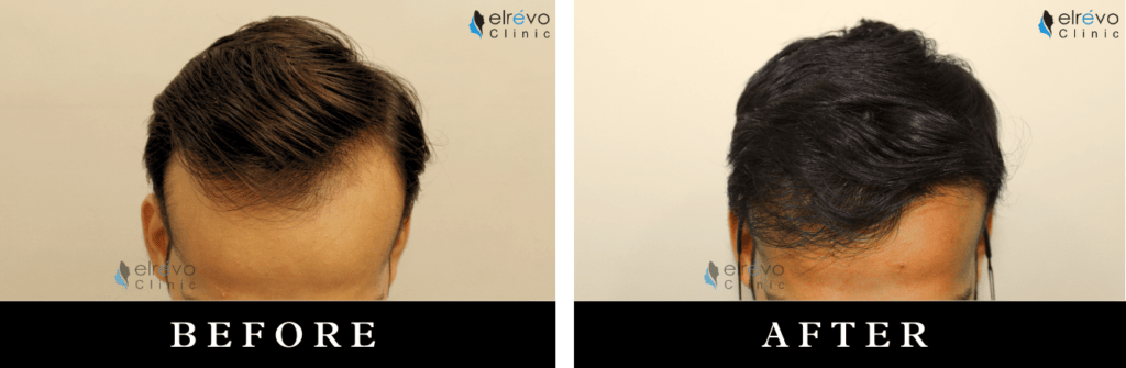 Before and after frontal hair restoration using FUE hair transplant at Elrevo Clinic by Dr. Ram Chilgar.