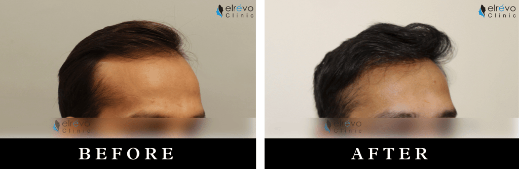 Before and after frontal hair restoration using FUE hair transplant at Elrevo Clinic by Dr. Ram Chilgar.