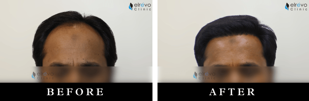 Fronto temporal high-density hair transplant results, before and after, at Elrevo Clinic by Dr. Ram Chilgar.