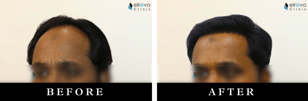 Before and after results of fronto temporal high-density hair transplant at Elrevo Clinic with Dr. Ram Chilgar.