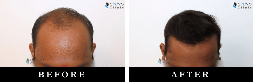 High-density hair restoration for advanced baldness at Elrevo Clinic, before and after results showcasing Dr. Ram Chilgar's expertise.