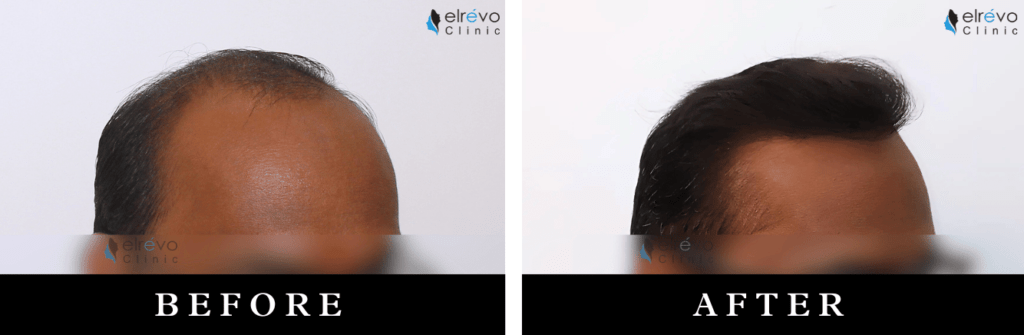 Before and after images of high-density hair restoration for advanced baldness at Elrevo Clinic with Dr. Ram Chilgar.