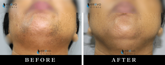Achieve smooth, hair-free skin with Advanced Laser Hair Reduction at Elrevo Clinic, led by Dr. Ram Chilgar. This image highlights outstanding Before & After results showcasing the effectiveness of cutting-edge laser hair removal technology. Enjoy permanent, painless unwanted hair removal with non-invasive, long-lasting results.