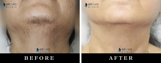 Discover advanced Laser Hair Reduction at Elrevo Clinic, led by Dr. Ram Chilgar, using state-of-the-art technology for permanent, painless unwanted hair removal. The image shows dramatic Before & After results, revealing smooth, hair-free skin following expert treatments, ensuring long-lasting, effective hair reduction