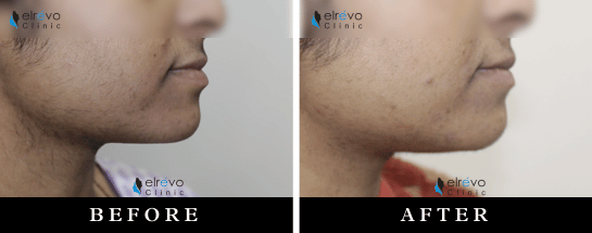 Experience the effectiveness of Laser Hair Reduction at Elrevo Clinic, led by Dr. Ram Chilgar. The image showcases impressive Before & After results, highlighting smooth, hair-free skin after a series of laser hair removal treatments. Achieve permanent hair reduction with advanced, non-invasive technology.