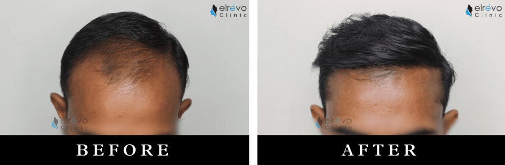 Before and after images of natural frontal hairline creation using FUE hair transplant at Elrevo Clinic.