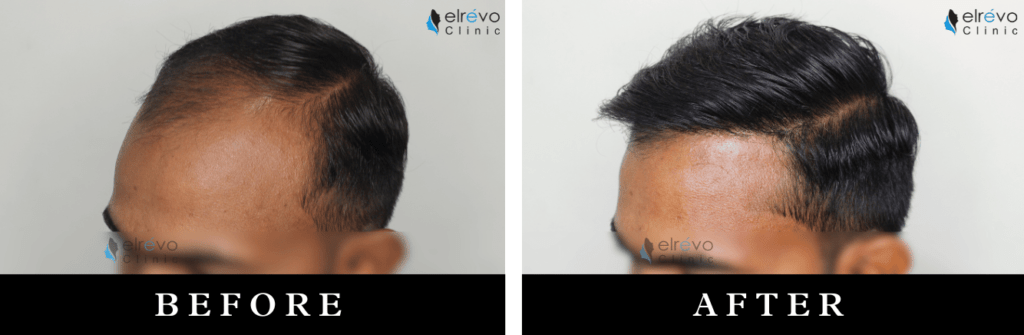 FUE hair transplant for natural frontal hairline creation at Elrevo Clinic – before and after by Dr. Ram Chilgar.