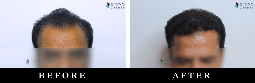 Natural hairline creation results showing a seamless and restored hairline after hair transplant, performed at Elrevo Clinic by Dr. Ram Chilgar.