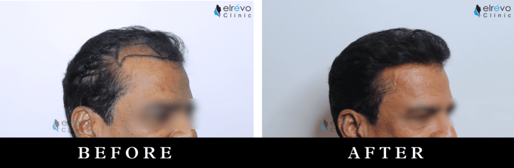 Natural hairline creation results showing a seamless and restored hairline after hair transplant, performed at Elrevo Clinic by Dr. Ram Chilgar.