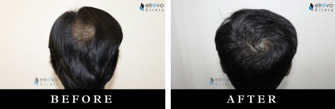 Advanced crown hair transplant results at Elrevo Clinic, showcasing the successful restoration of natural hair growth in the crown area using the latest FUE technique under the expertise of Dr. Ram Chilgar.