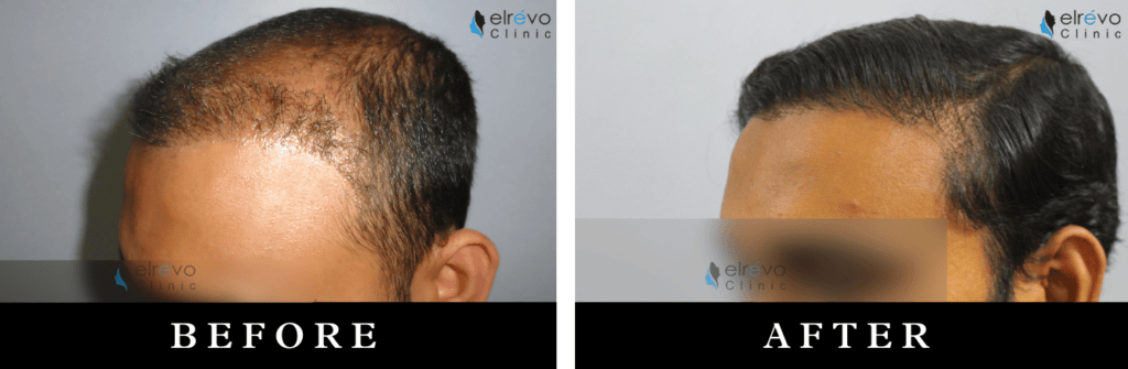 Revision hair transplant at Elrevo Clinic by Dr. Ram Chilgar, offering expert correction of previous hair transplant results, restoring natural hairlines and density for optimal results.
