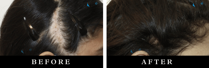 Restore your hairline and confidence with Scar Hair Transplant at Elrevo Clinic, led by Dr. Ram Chilgar. The image showcases incredible results in hair restoration using the FUE technique for patients with scars, whether from surgery or trauma, helping them achieve natural hair regrowth in scarred areas.