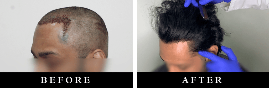 Temple hairline creation at Elrevo Clinic by Dr. Ram Chilgar, expertly designed to restore a natural and symmetrical temple area, offering a youthful and balanced facial appearance.