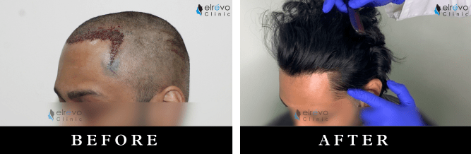 Temple hairline creation results showing a natural and well-defined temple area after hair transplant, performed at Elrevo Clinic by Dr. Ram Chilgar.