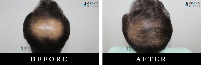 Advanced crown hair transplant results at Elrevo Clinic, showcasing the successful restoration of natural hair growth in the crown area using the latest FUE technique under the expertise of Dr. Ram Chilgar.