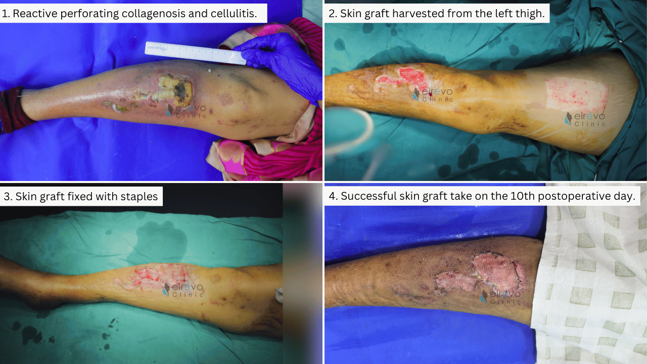 A step-by-step visual representation of the treatment of a diabetic patient with reactive perforating collagenosis and cellulitis, including wound debridement, skin graft harvesting, graft fixation, and successful healing.